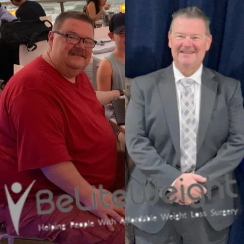 Weight Loss Surgery Before And After